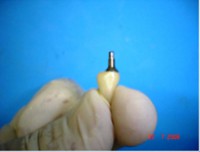 /album/galeria-de-fotos-carga-imediata-apos-exodontia-atraumatica-/carga-imediata-com-exodontia-atraumatica17-jpg/